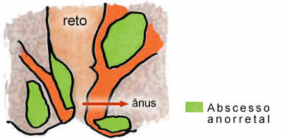 abscesso03