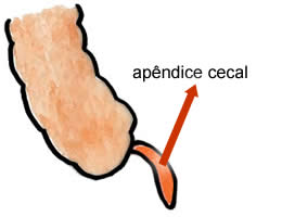 apendicite_aguda