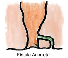 fistula_anorretal