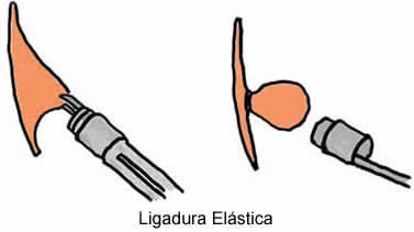 ligadura_elastica