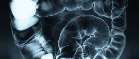 Síndrome do Intestino Irritável (SII): quais as causas desta doença?