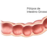 Pólipos de intestino grosso e seus riscos