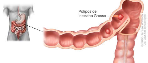 Pólipos de intestino grosso e seus riscos