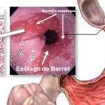 Esôfago de Barrett: medicação ou cirurgia?