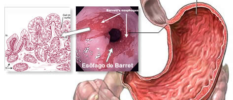 Esôfago de Barrett: medicação ou cirurgia?