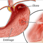 O que é Úlcera Péptica (estômago e duodeno) ?
