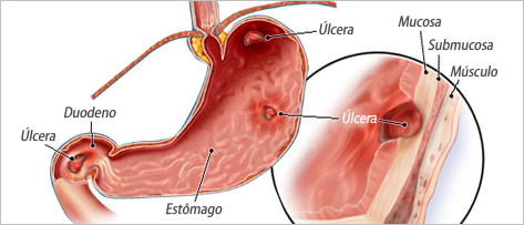 O que é Úlcera Péptica (estômago e duodeno) ?