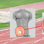 “Hérnia do Esporte” (dor inguinal do atleta): o que significa esta alteração?