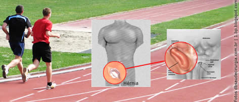 “Hérnia do Esporte” (dor inguinal do atleta): o que significa esta alteração?