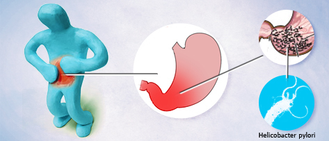 Helicobacter pylori e as suas relações com a gastrite, úlcera e câncer de estômago