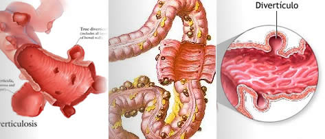 Divertículo, diverticulose e diverticulite: qual a diferença?