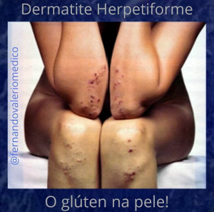 Doença Celíaca (glúten) e Dermatite Herpetiforme
