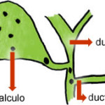 Cálculo de Vesícula Biliar ( Colelitíase )