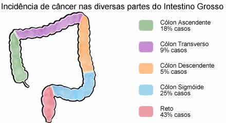 Câncer de Intestino Grosso ( Colorretal )