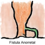 Fístula Perianal