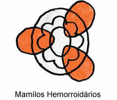 Hemorróida