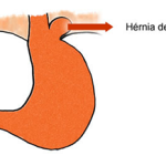 Refluxo Gastroesofágico e Hérnia de Hiato