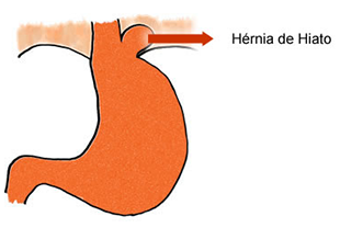 Refluxo Gastroesofágico e Hérnia de Hiato