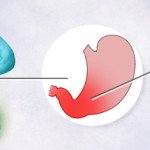 Helicobacter pylori e as suas relações com a gastrite, úlcera e câncer de estômago