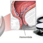Hemorróidas e Proctologista: por que ser avaliado por este especialista?