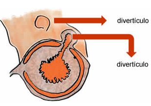 Diverticulite Aguda